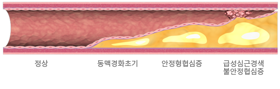 동맥경화 진행과정