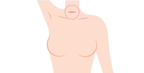 일반 수술 : 목 절개