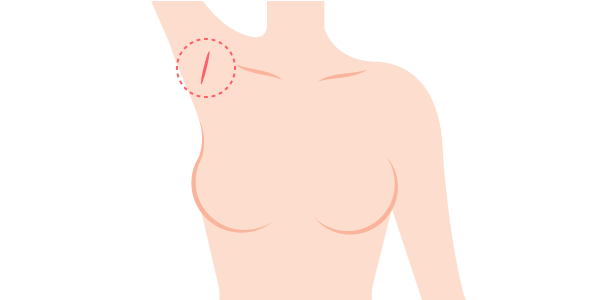 로봇 수술 : 겨드랑이 절개