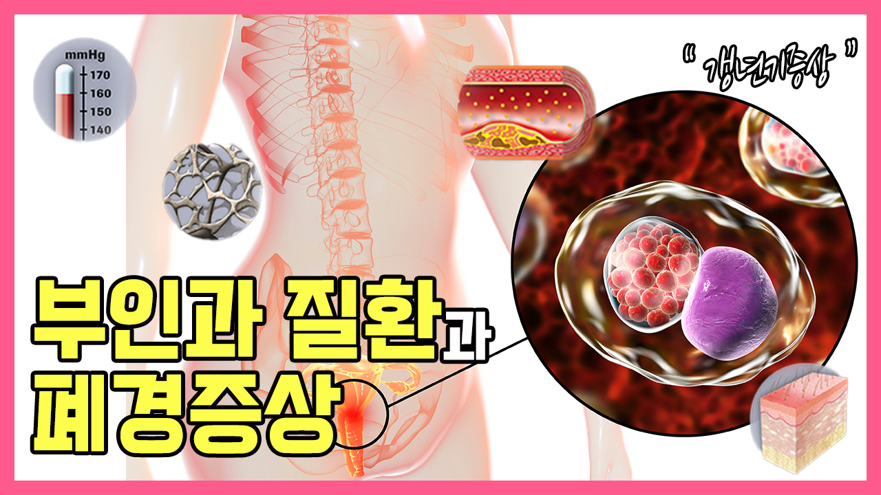 유방암 환자가 알아둬야 할 부인과 질환과 폐경 증상! 