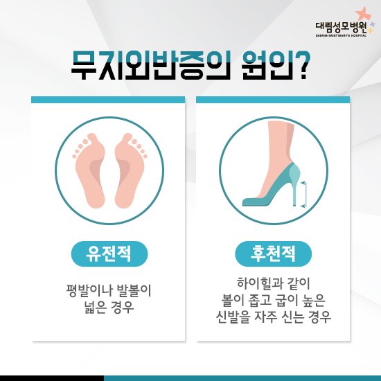 [척추관절센터] 무지외반증 3.jpg