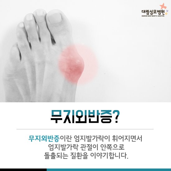 [척추관절센터] 무지외반증 2.jpg