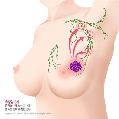 [유방센터] 유방암 전이재발과 치료 2.jpg