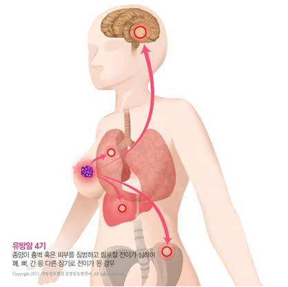[유방센터] 유방암 전이재발과 치료 2_1.jpg