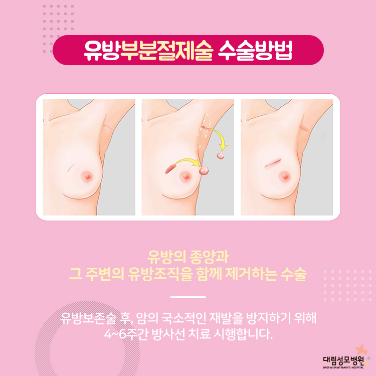 [유방센터] 유방암 수술 5.jpg