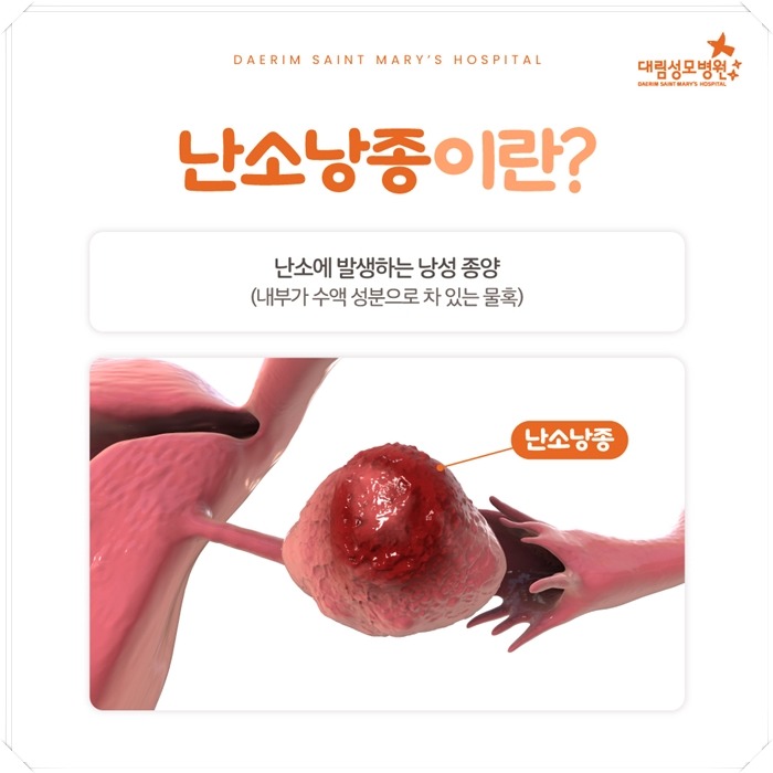 250407_대림성모병원_바이럴_난소낭종_(2).jpg