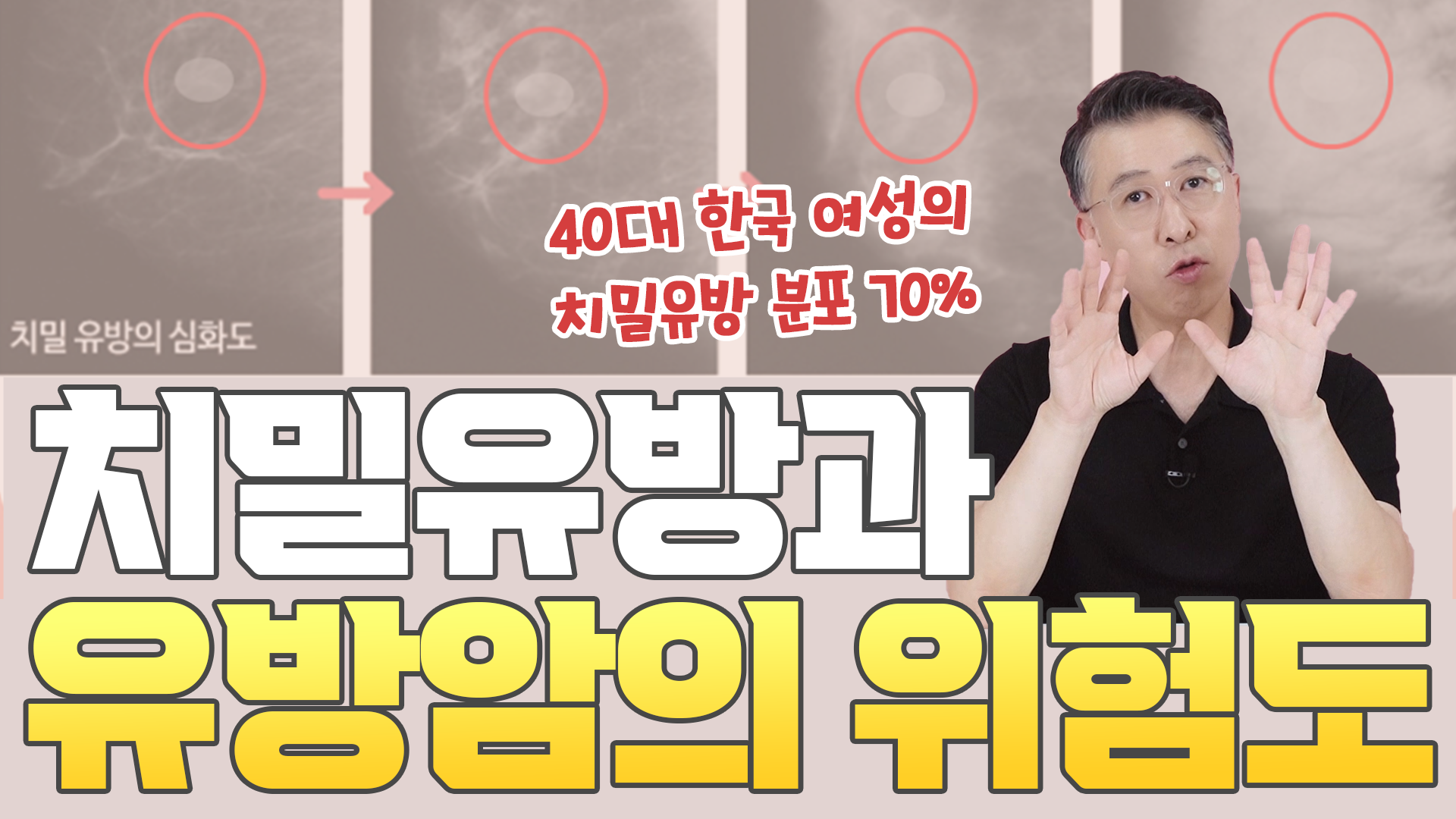 나의 유방은 안전할까? 치밀도에 따른 유방암 발생의 위험성  