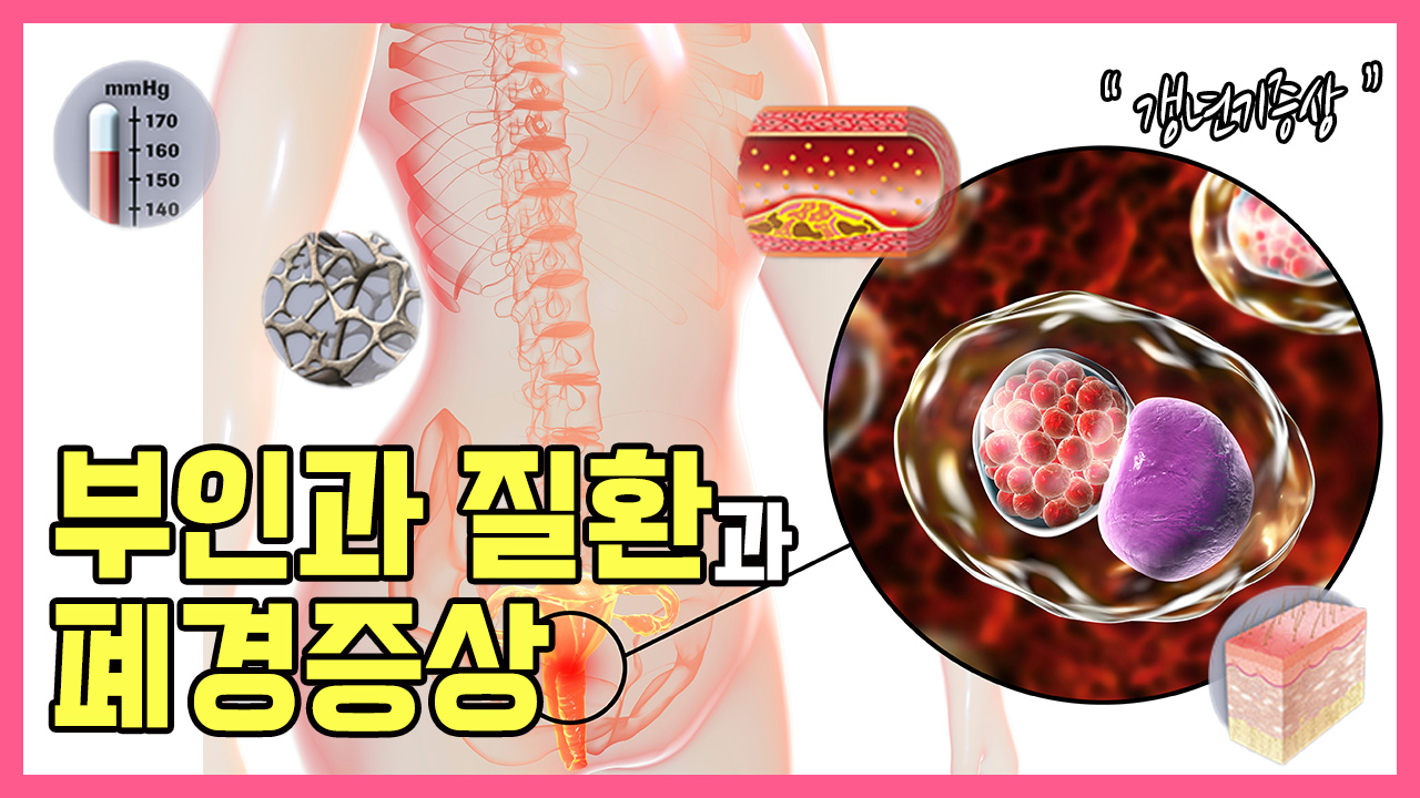 유방암 환자가 알아둬야 할 부인과 질환과 폐경 증상!  