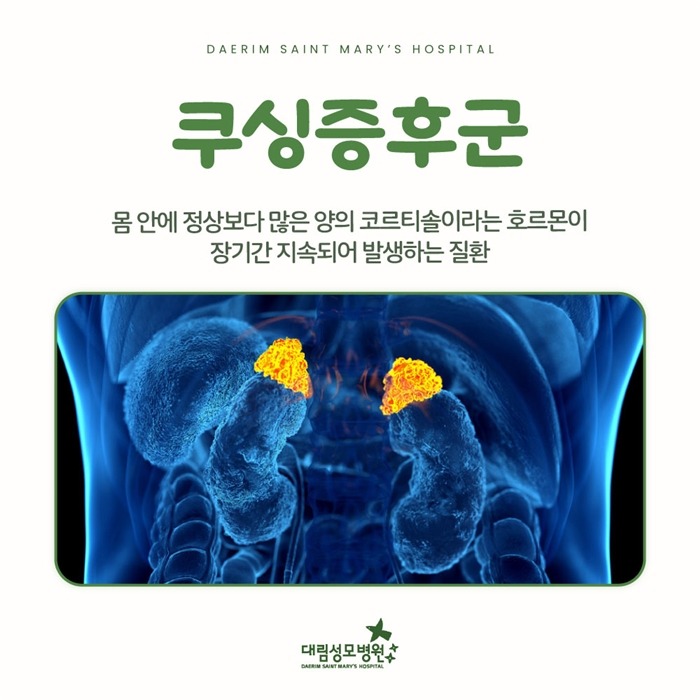 250219_대림성모병원_바이럴_쿠싱증후군_(2).jpg